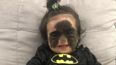ELLE EST NÉE AVEC UNE TACHE DE NAISSANCE EN FORME DE MASQUE. DÉCOUVREZ SA TRANSFORMATION ÉPOUSTOUFLANTE APRÈS L’OPÉRATION !