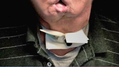 Il a passé sept ans sans visage après un accident, mais voyez comment la chirurgie l’a transformé.