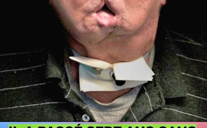 Il a passé sept ans sans visage après un accident, mais voyez comment la chirurgie l’a transformé.